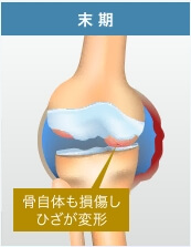 膝関節症・末期